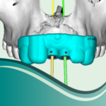 I16-Planificación Diseño e impresión de guias quirurgicas